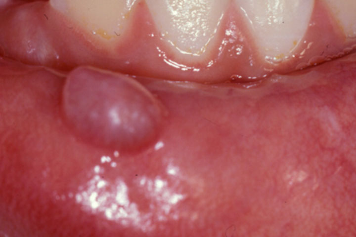 Mucocele