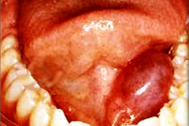 Plunging Ranula - Inside the mouth